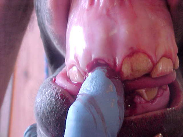 extract 08incisor