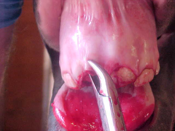 extract 09incisor