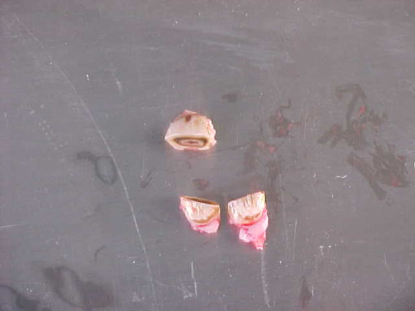 extract 13incisor